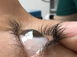 Realiza personal de la Secretaría de Salud dos trasplantes de córnea