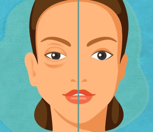 La Secretaría de Salud se suma al Día Mundial del Angioedema Hereditario